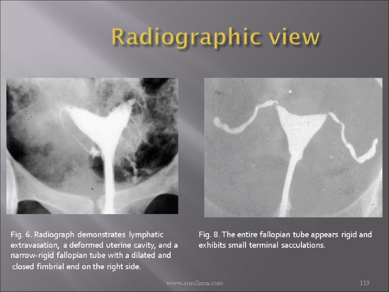 Radiographic view www.similima.com  119 Fig. 6. Radiograph demonstrates lymphatic extravasation, a deformed uterine